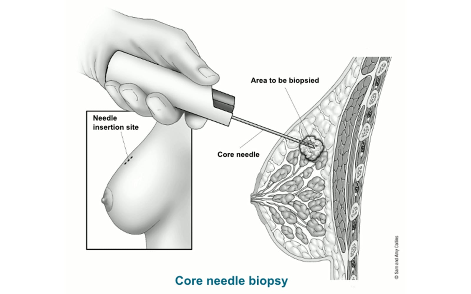 core-biopsy-general-1